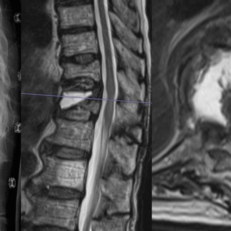 X-ray (left) showing a vertebral wedge fracture. MRI (middle, right ...