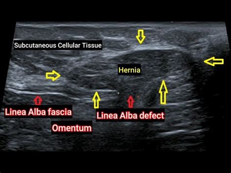 Linea Alba Hernia