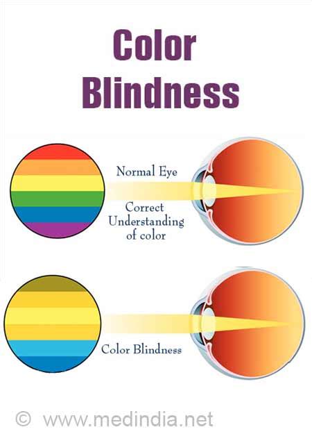 Is There A Cure For Color Blindness? Exploring Potential Solutions