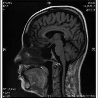 MRI Brain showing empty sella (red arrow) in our patient. | Download ...