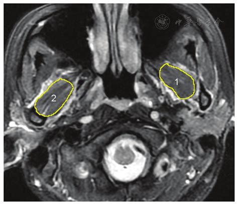 Functional changes of the lateral pterygoid muscle in patients with ...