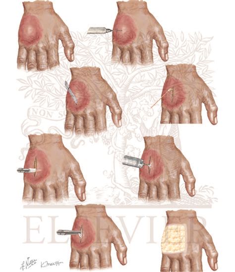 Incision And Drainage Of Perirectal Abscess Cpt Code