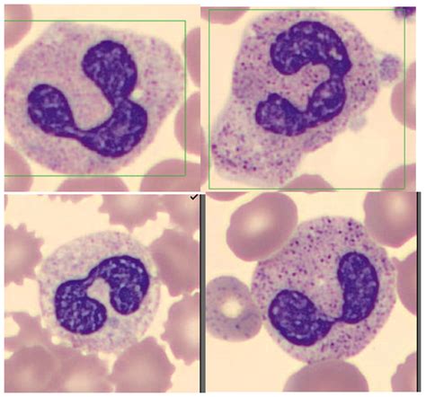 Band Neutrophils