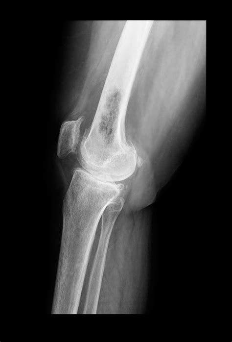 Bone Cancer | MedlinePlus