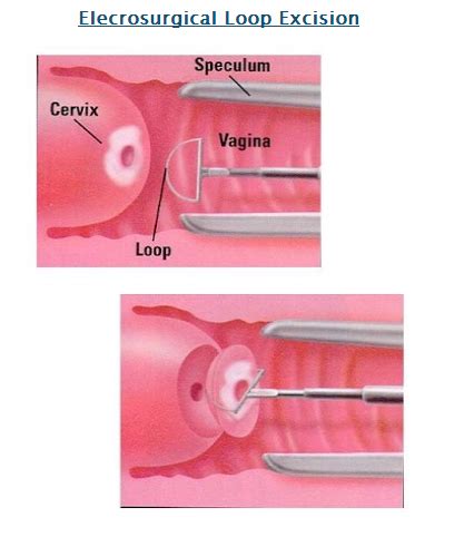 Abnormal Pap Smear Hpv