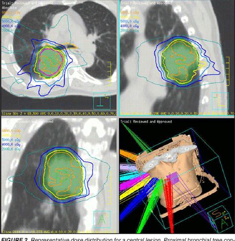 Figure 1 from Stereotactic body radiation therapy (SBRT) for lung ...