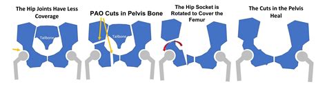 Periacetabular Osteotomy: Should You Get Hip PAO Surgery? - Regenexx