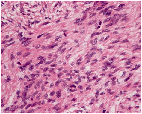 High-intensity focused ultrasound for treatment of recurrent uterine ...