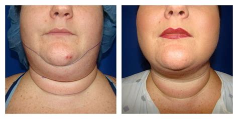 Chin Liposuction / Smartlipo in Houston TX