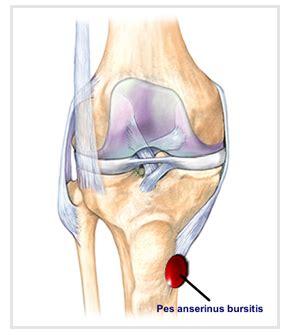 Pes Anserine Bursitis Natural Treatment | OSMO Patch US