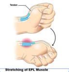 Extensor pollicis longus : Origin,Insertion,Action,Exercise