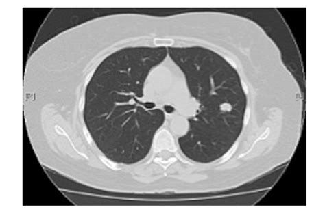 Early Lung Cancer Ct Scan