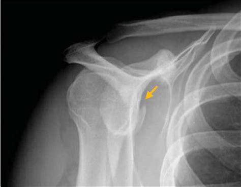 Acute Bony Bankart Lesion and Surgical Fixation | Journal of ...