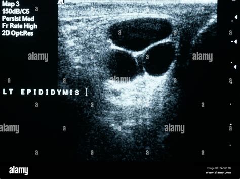 Epididymal cysts. Ultrasound scan of epididymal cysts (three black ...