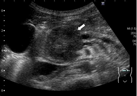 Solid pseudopapillary neoplasm of the pancreas in a young male with ...