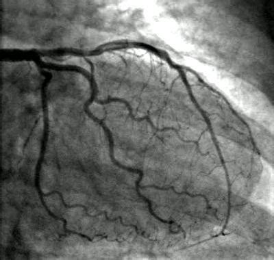 Angiogram