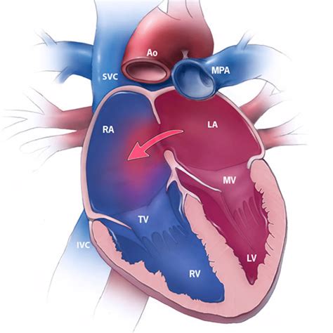 Ventricular Septal Defect