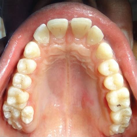 Maxillary cross sectional occlusal radiograph showing erupted paramolar ...