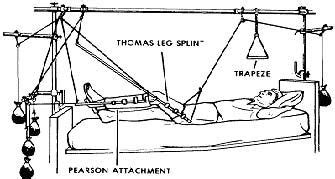 Bucks Traction Complications - FrankClark