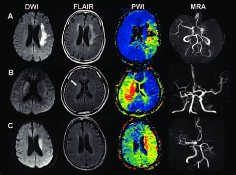 Representative figures showing diffusion-weighted imaging... | Download ...