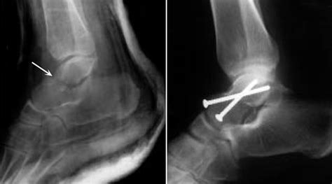 Talus Fracture