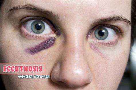 Ecchymosis; Definition, Symptoms, Causes and Treatments