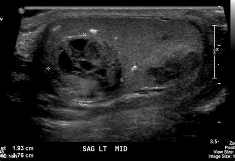 Testicular Tumour – Undergraduate Diagnostic Imaging Fundamentals