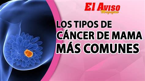 ¿QUÉ ES EL CANCER DE MAMA? Y LOS DIFERENTES TIPOS DE CANCER - El Aviso ...