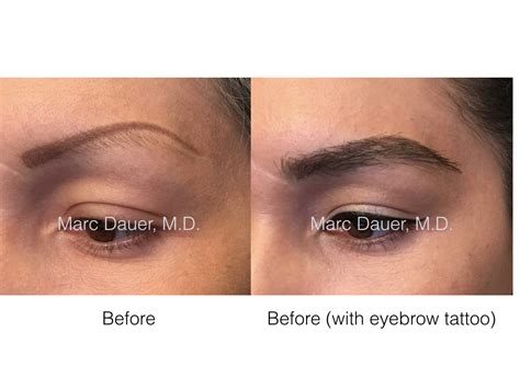 Eyebrow Restoration Los Angeles, Eyebrow Transplant Procedure