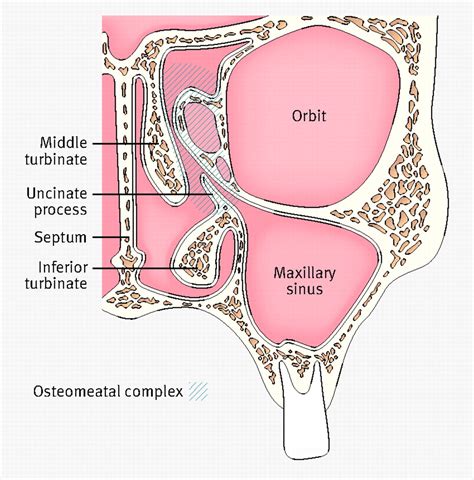 Sinusitis and its management | The BMJ