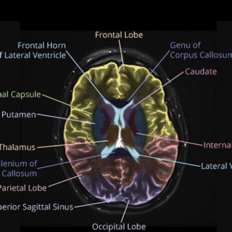 Mri Anatomy Brain Axial Image With Images Brain Anatomy Mri Mri | The ...