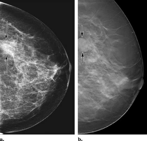 Comparison of screening mammography with breast tomosynthesis in a ...