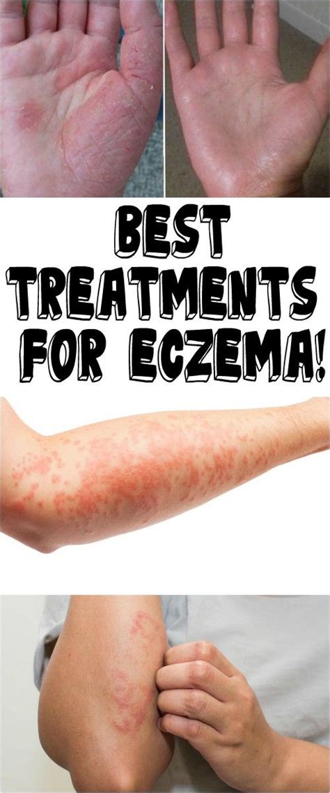 BEST TREATMENTS FOR ECZEMA! - HEALTH ROOTS