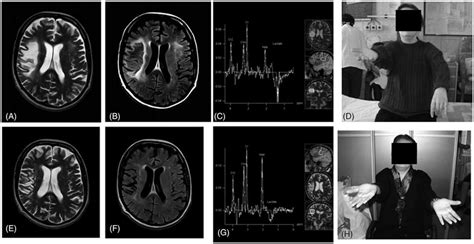 A-D October 2009. (A) T2-weighted MRI, (B) FLAIR MRI, (C) magnetic ...