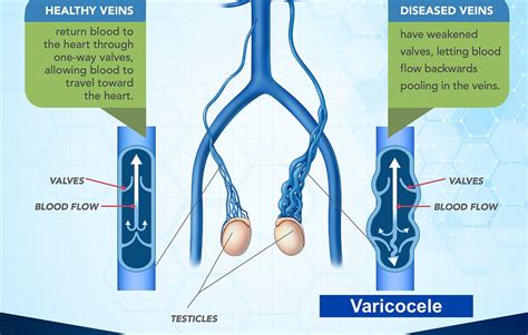 Varicocele Embolization: Day-care treatment for varicocele; a silent ...