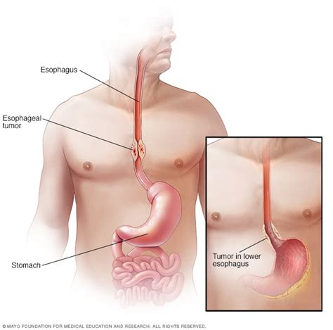 Esophageal cancer - Symptoms and causes - Mayo Clinic