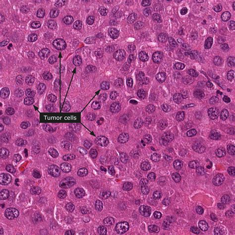 Hepatocellular Carcinoma Histology