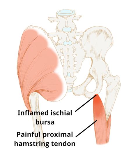 Ischial (sitting bone) bursitis pain - Circle Integrated Care