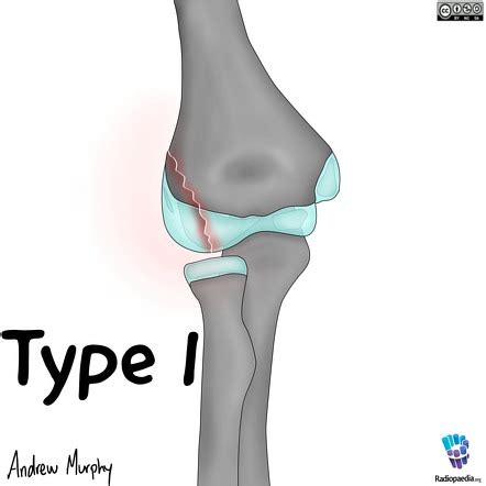 Lateral Condyle Fx Humerus Closed