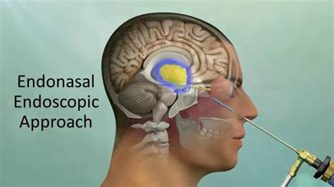 Endoscopic Endonasal Craniopharyngioma Surgery - YouTube