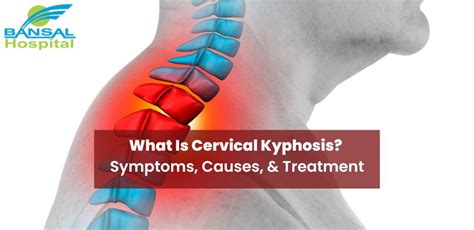 What Is Cervical Kyphosis? Symptoms, Causes, And Treatment