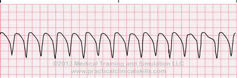 ECG Practice Drill