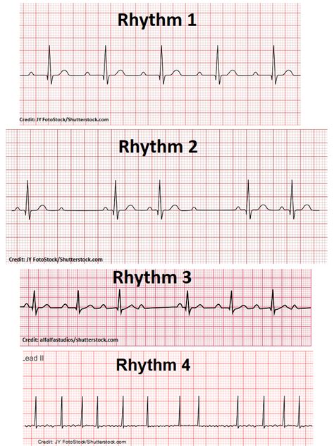 atrial-fibrillation