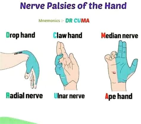 Ulnar Nerve Injury Claw Hand