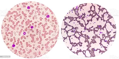 Blood Film Or Peripheral Blood Smear Microcytic Hypochromic Anemia With ...