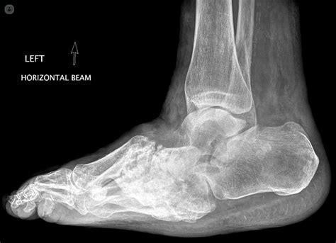 Charcot foot: what is it, symptoms and treatment | Top Doctors