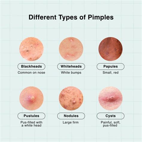 Why Am I Getting Pimples On My Chest Area at Kathleen Perry blog