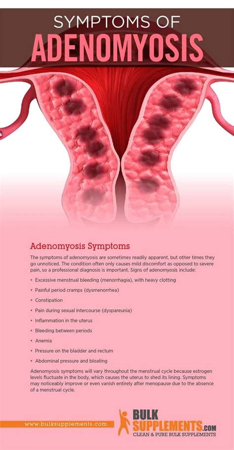 What is Adenomyosis: Causes, Symptoms & Treatment in 2021 | Adenomyosis ...