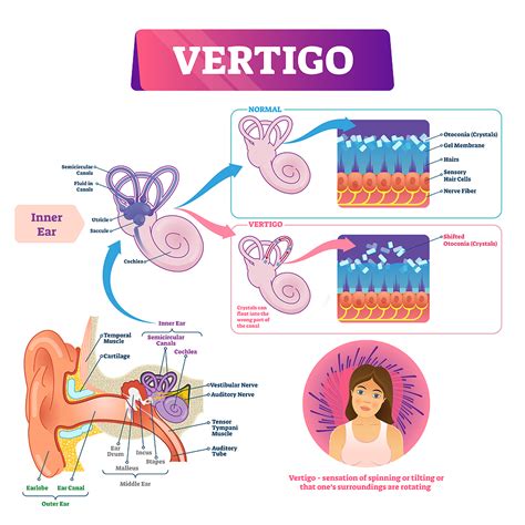 Vertigo Vector Illustration. Labeled Medical Vestibular Ear Prob ...