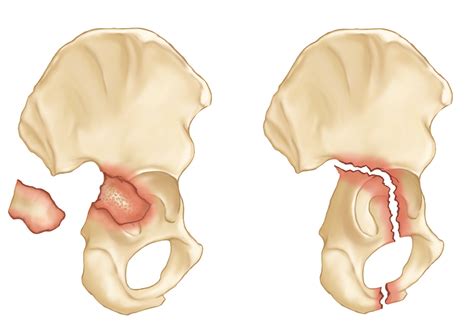 Acetabulum